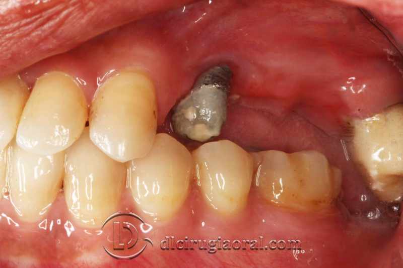 explantation and implantation with sinus lift