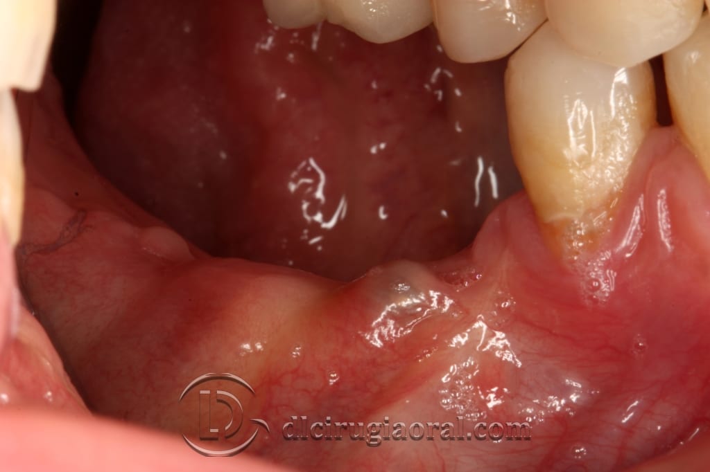 implant surgery in the mandible
