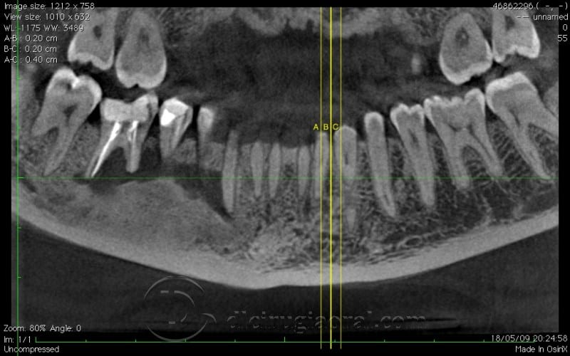 mandibular reconstruction