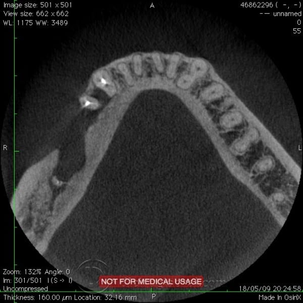 mandibular reconstruction