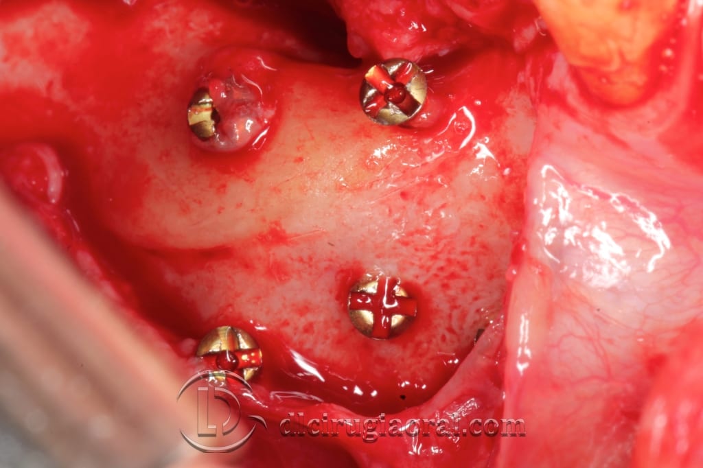 implant surgery in the mandible