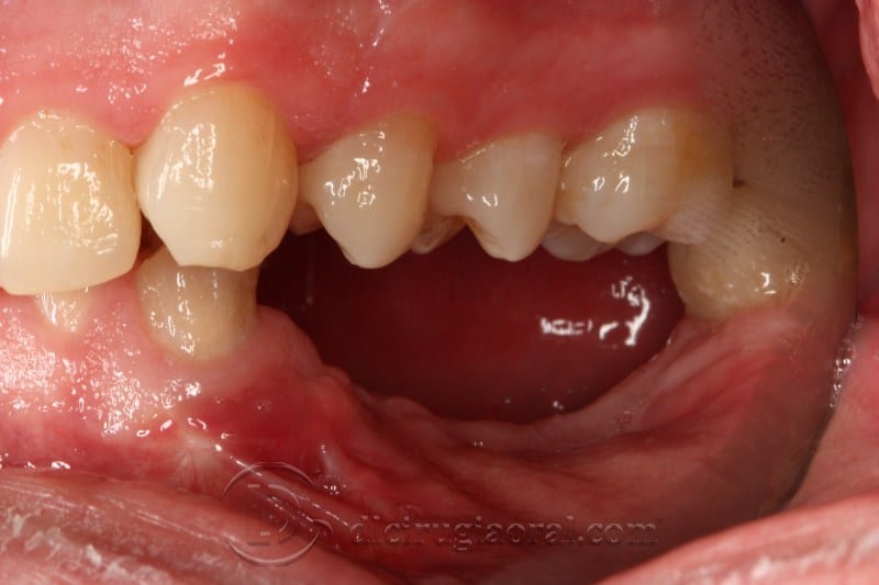 mandibular reconstruction