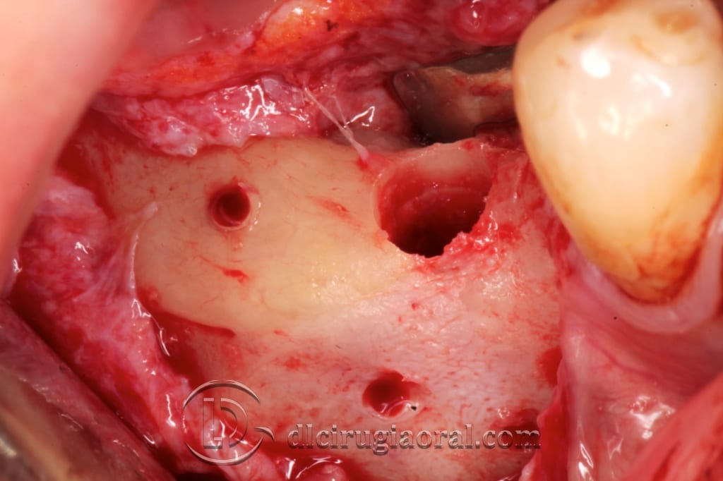 Implant Surgery in the Mandible After 9mm Vertical Reconstruction