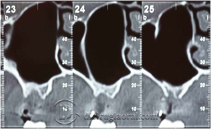 Explantation and Implantation with Sinus Lift: Rehabilitating the Posterior Maxilla