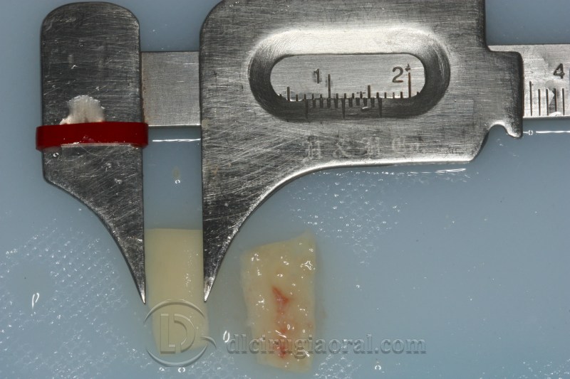 atrophy in central incisor