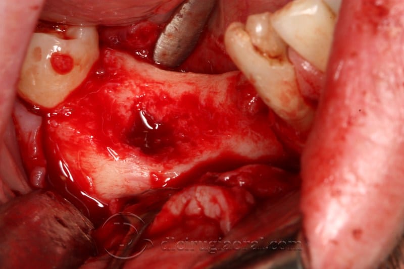 mandibular reconstruction