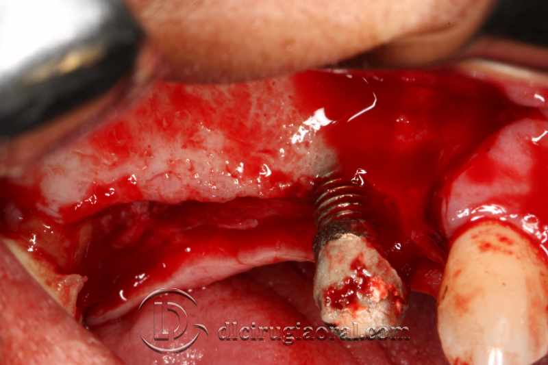 explantation and implantation with sinus lift