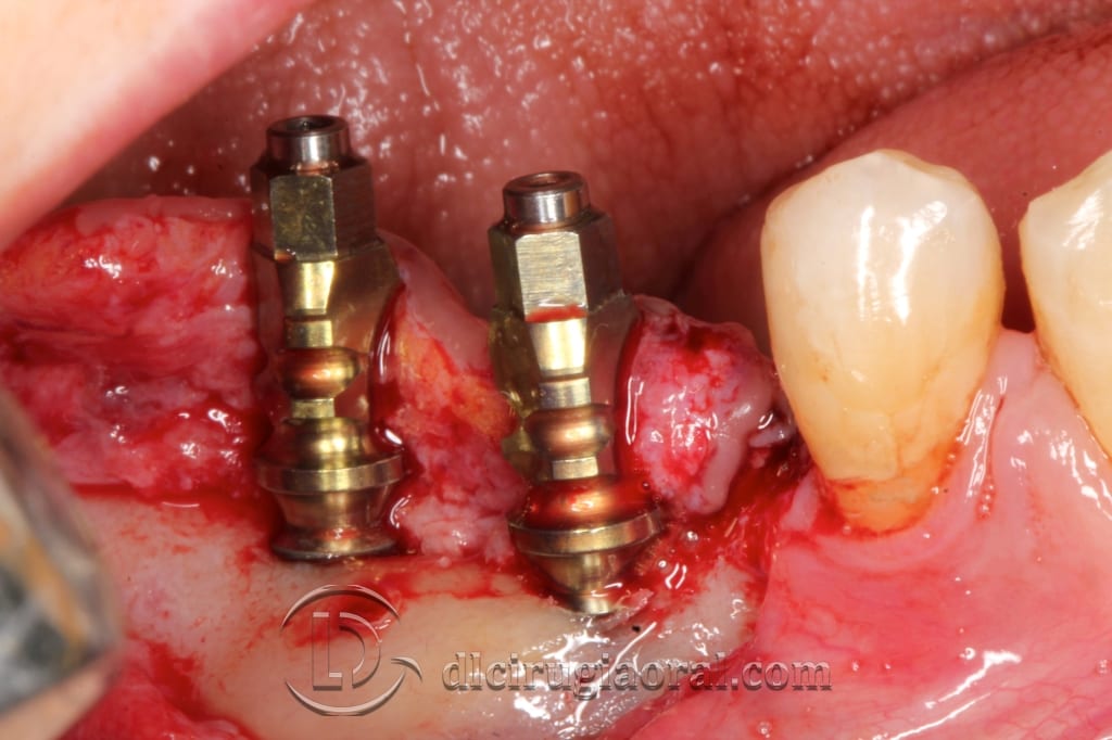 implant surgery in the mandible