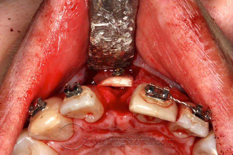 atrophy in central incisor