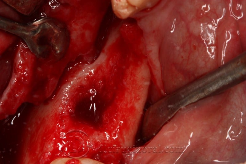 mandibular reconstruction