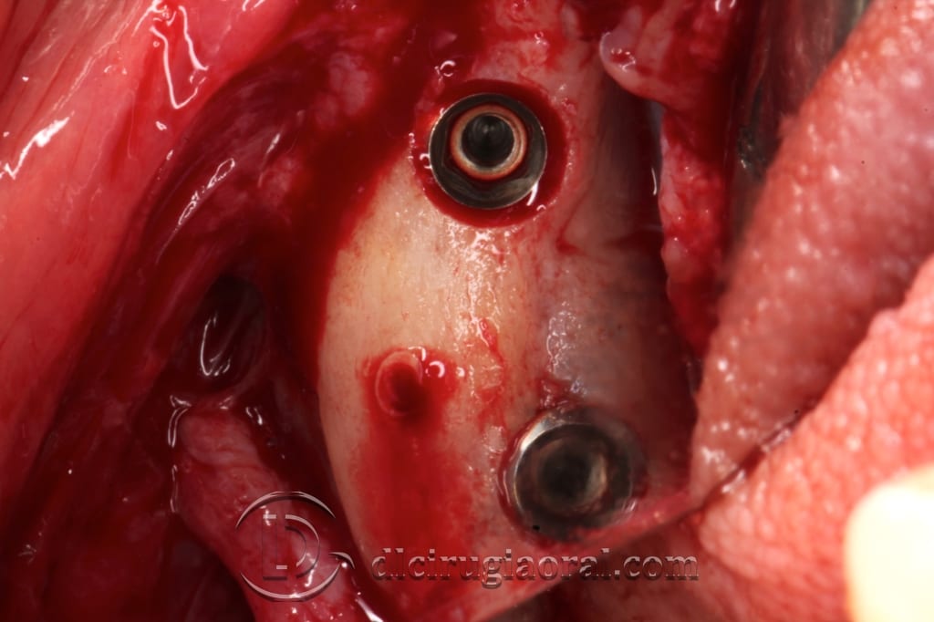 implant surgery in the mandible