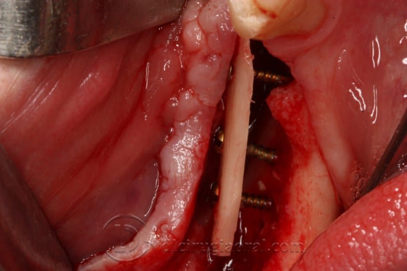 mandibular reconstruction