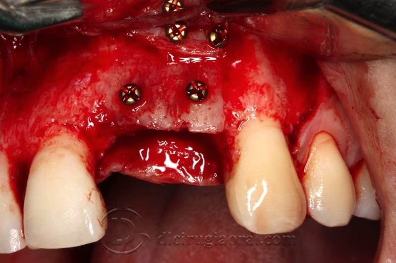 Appearance of graft