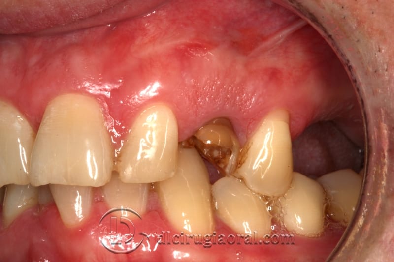 extraction of impacted canine