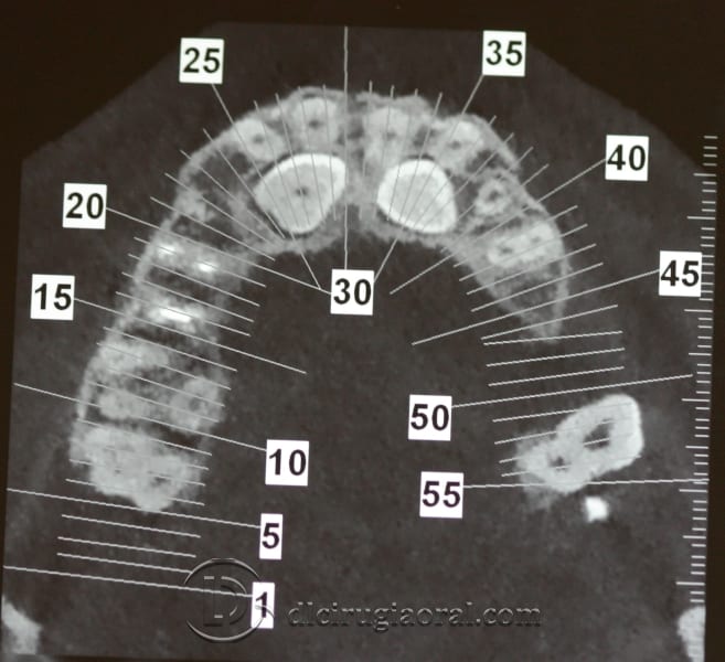 extraction of impacted canine
