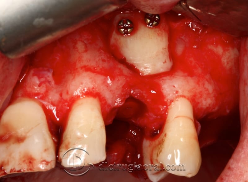 extraction of impacted canine