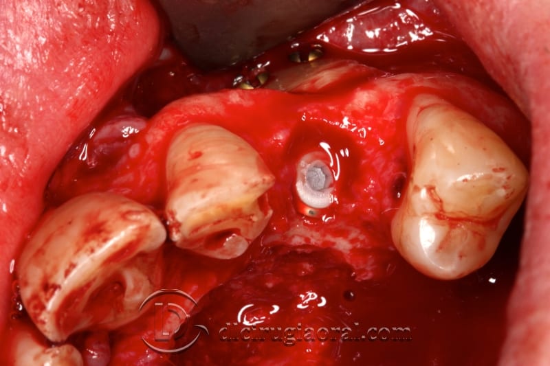 extraction of impacted canine