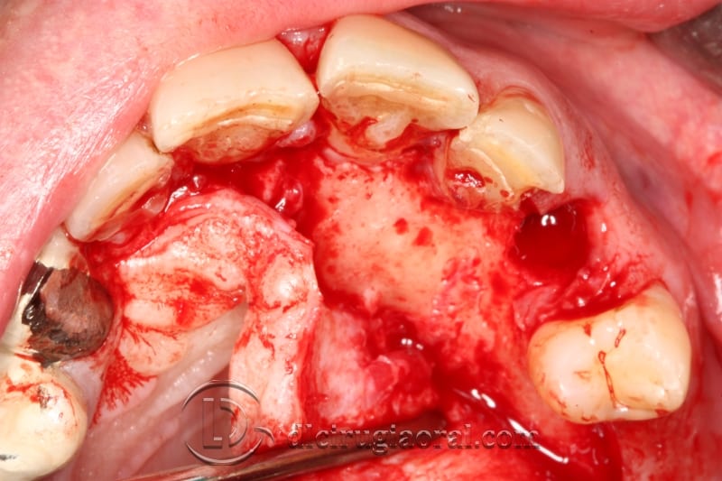 extraction of impacted canine