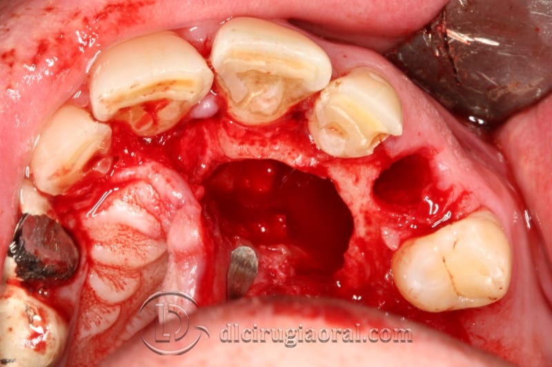 extraction of impacted canine