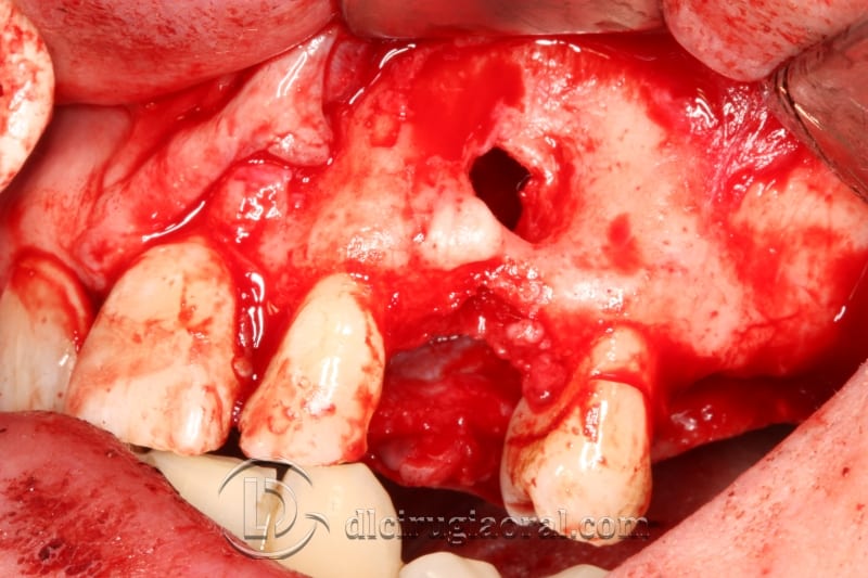 extraction of impacted canine