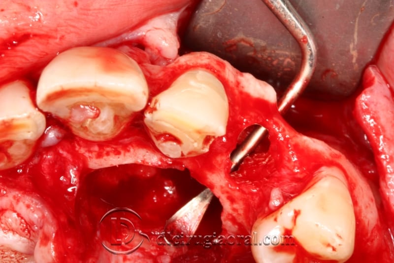 Extraction of Impacted Canine with Immediate Implant and Reconstruction