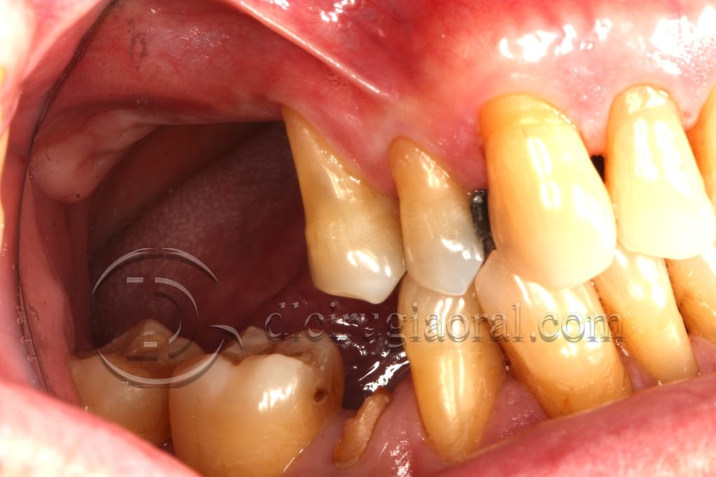 Course in maxillary reconstruction