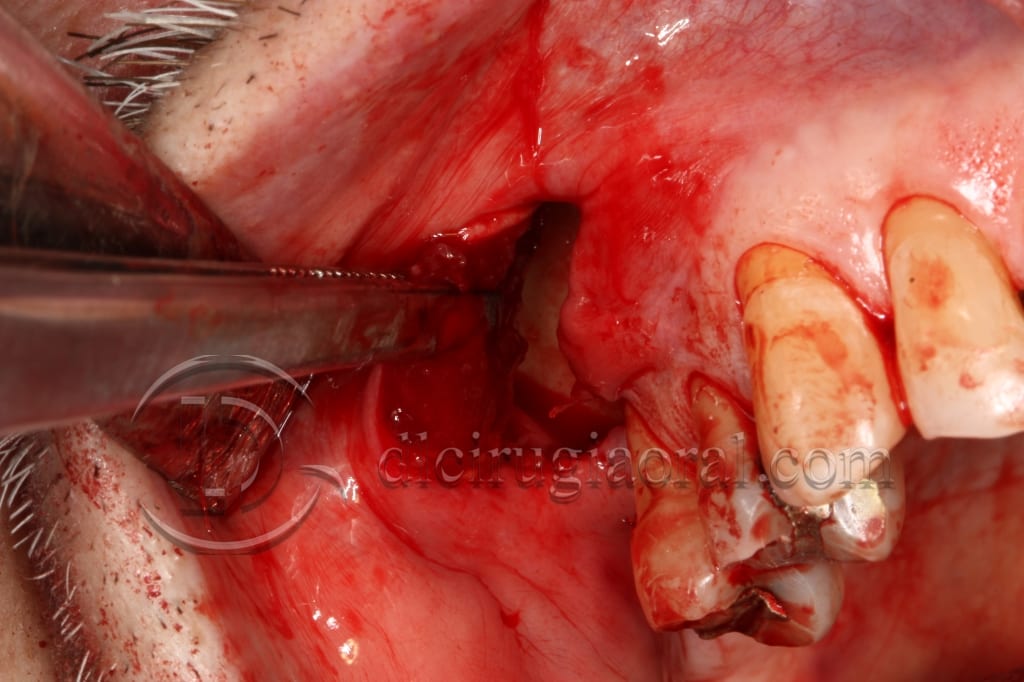 Course in maxillary reconstruction