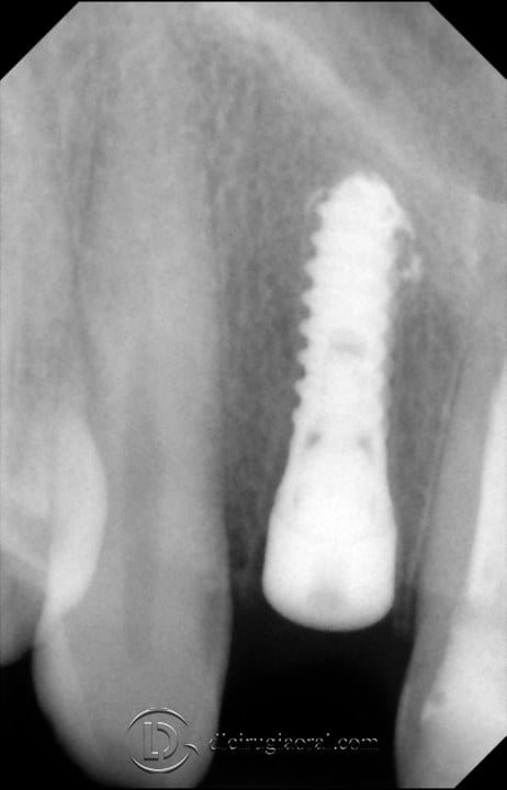 post-extraction implant