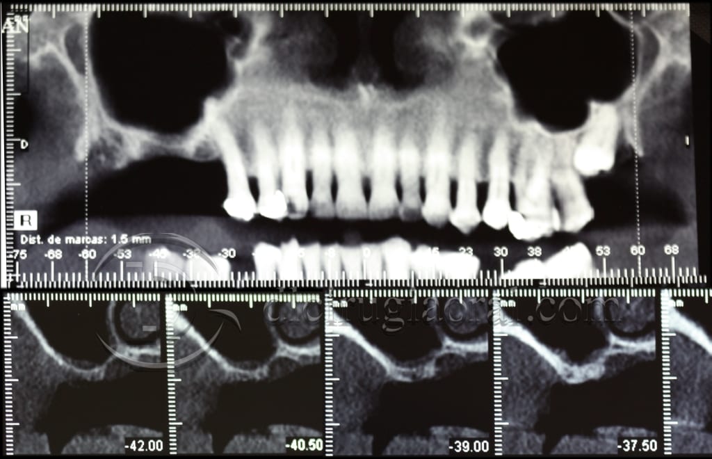 Course in maxillary reconstruction