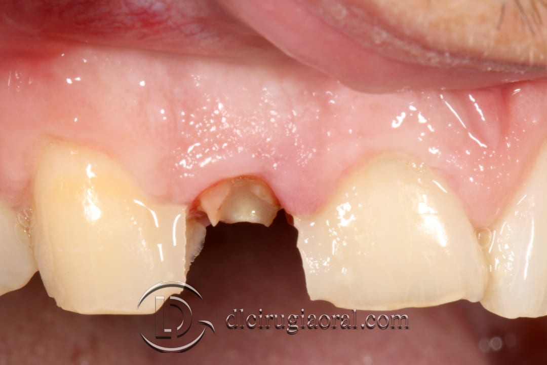 post-extraction implant