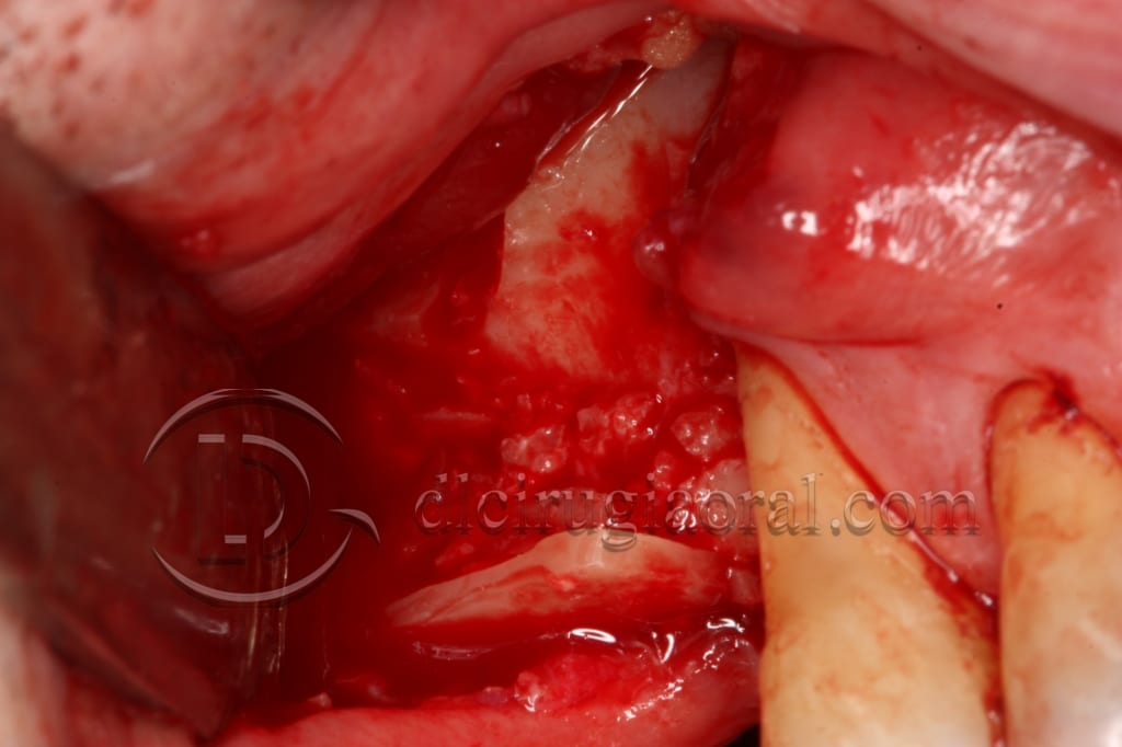 Course in maxillary reconstruction