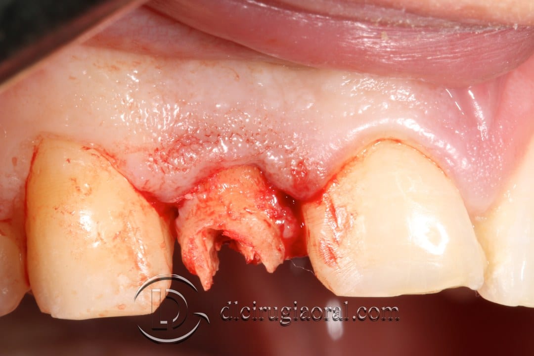 post-extraction implant