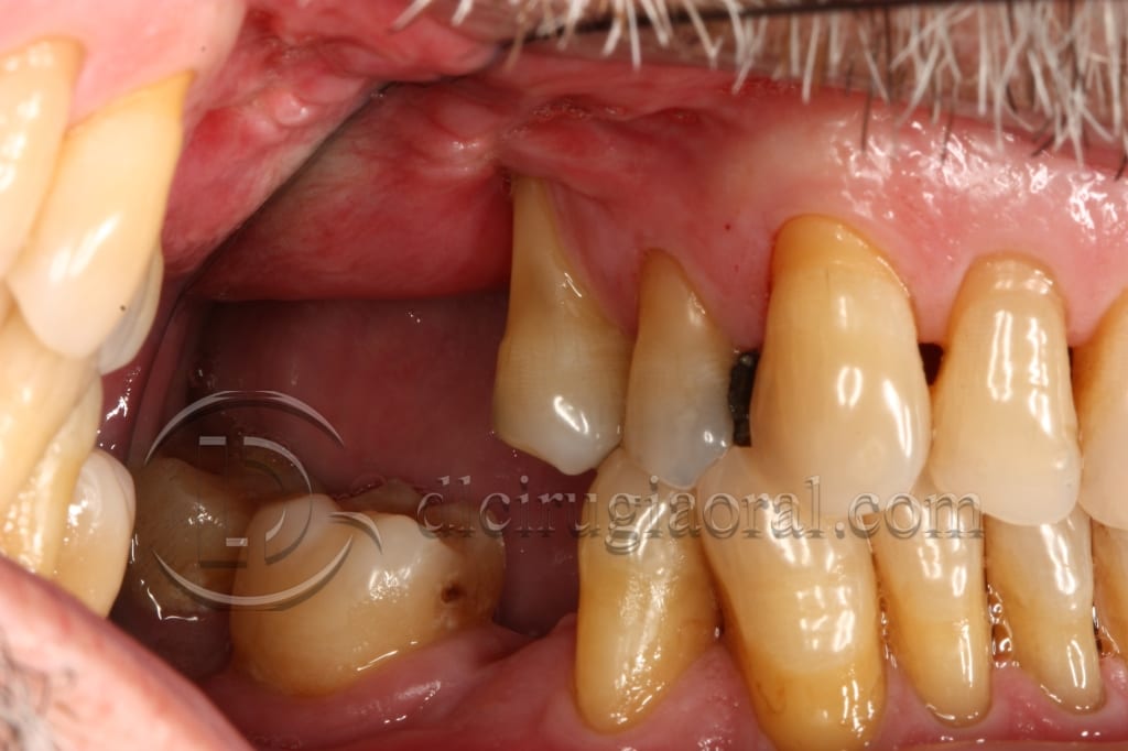 Course in maxillary reconstruction