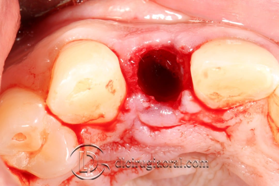 post-extraction implant