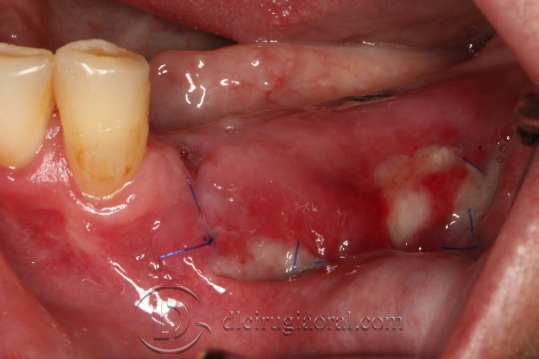 vestibuloplasty and implant in one surgery