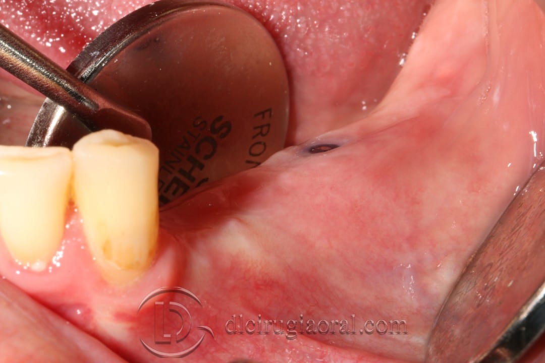 vestibuloplasty and implant in one surgery