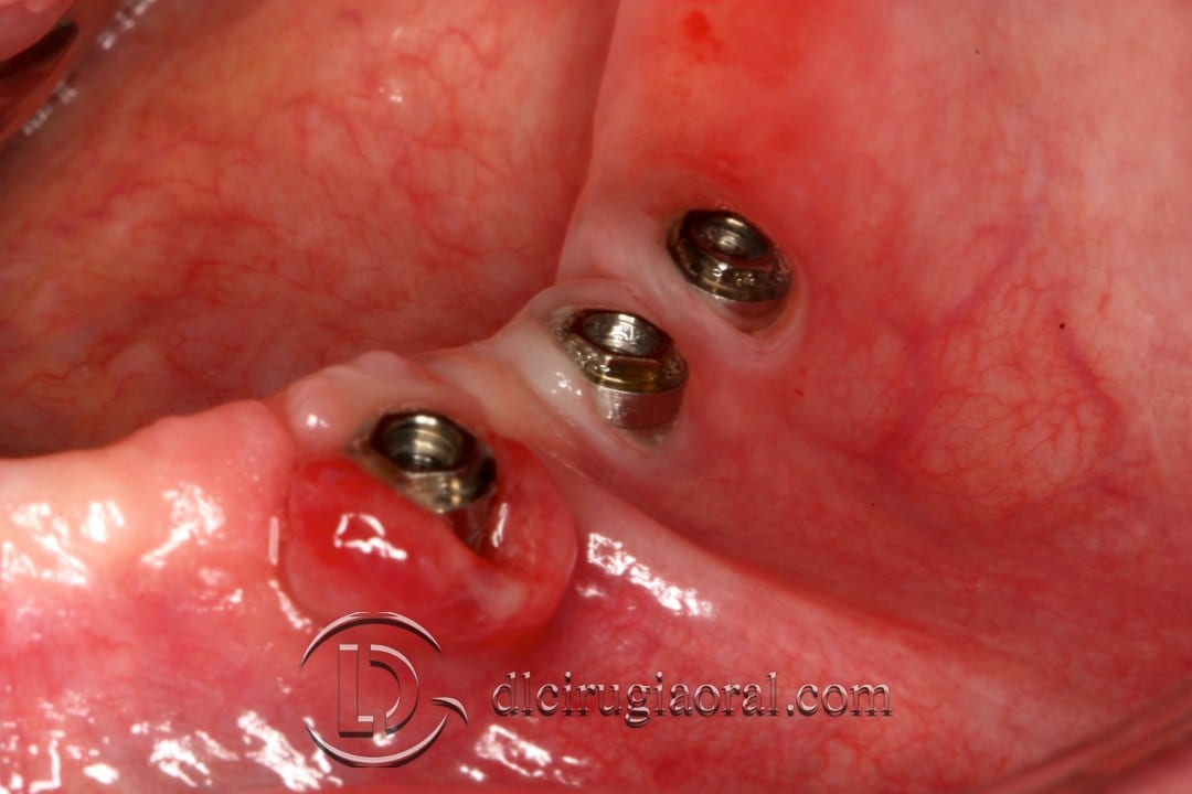 epithelial free graft