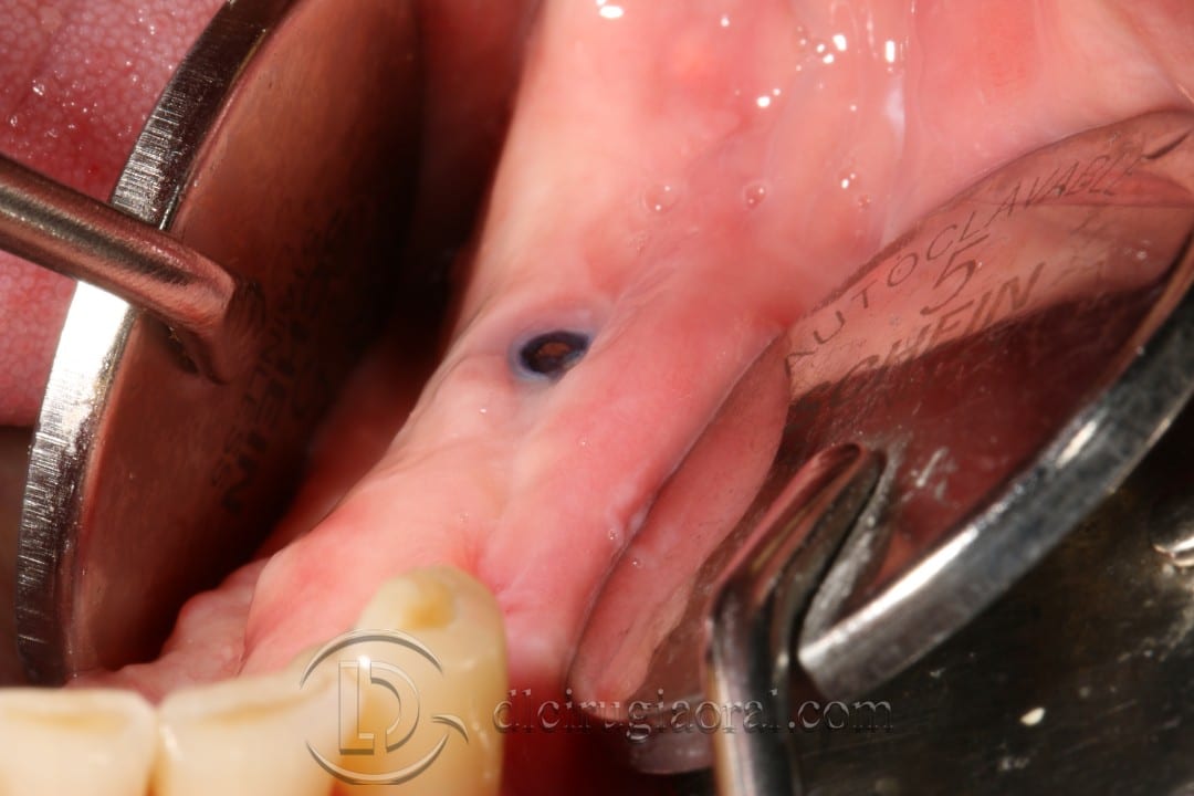 vestibuloplasty and implant in one surgery