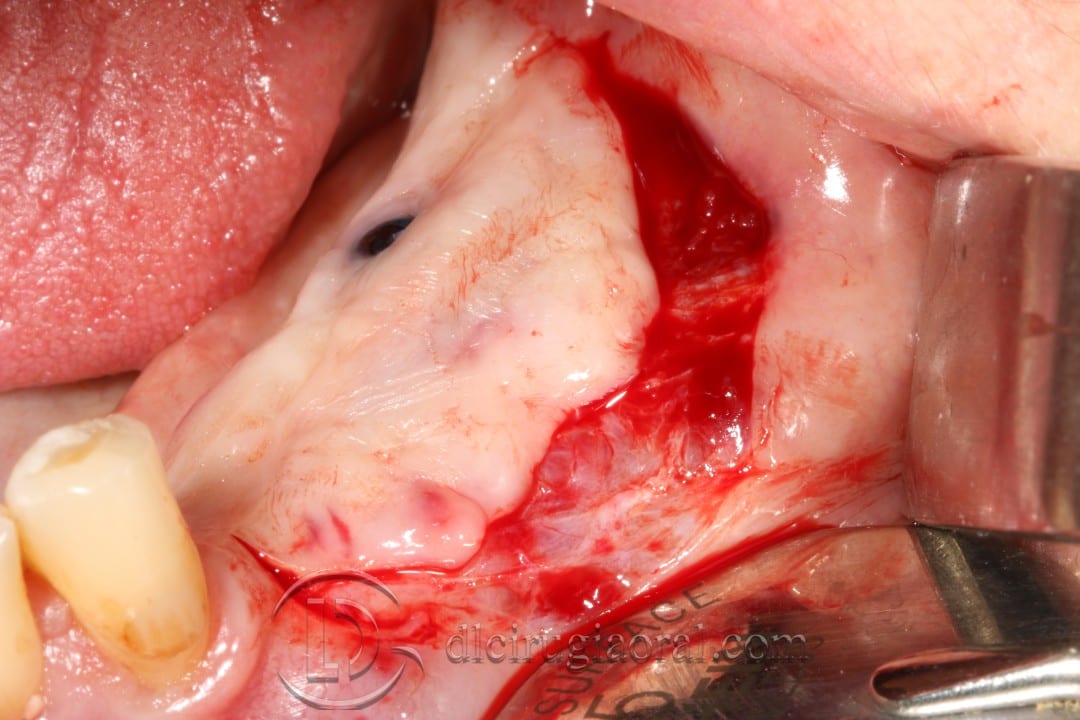vestibuloplasty and implant in one surgery
