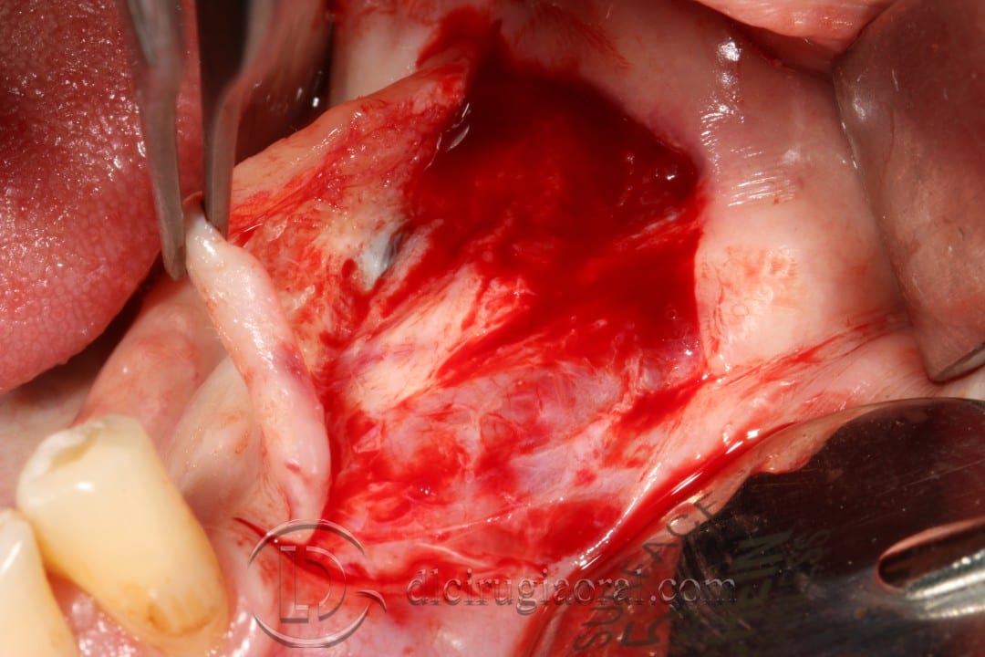 vestibuloplasty and implant in one surgery
