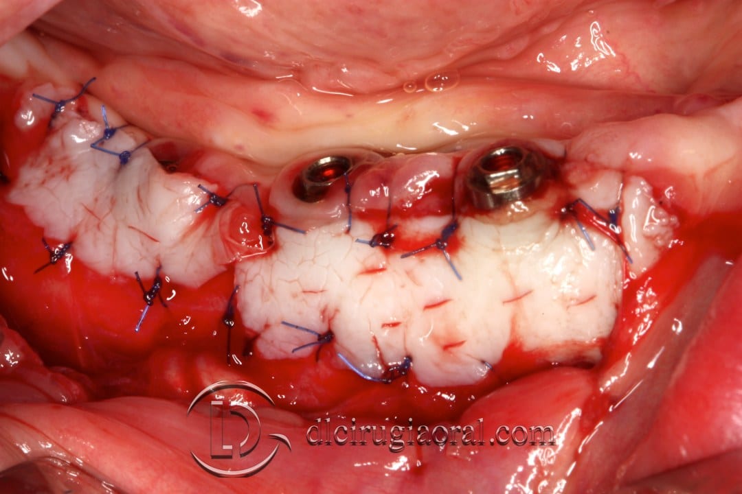 epithelial free graft