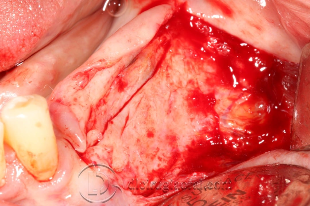 vestibuloplasty and implant in one surgery