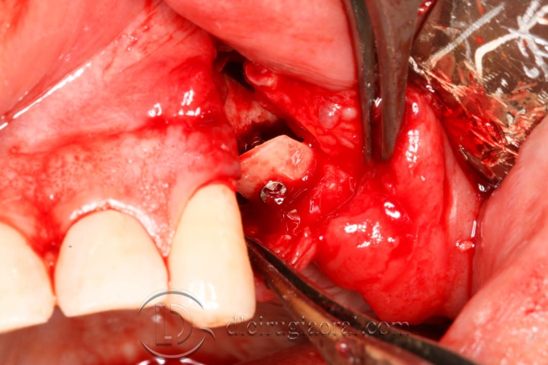 post-extraction implant connective tissue graft