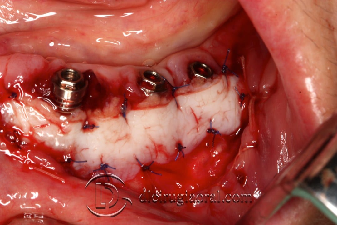 Epithelial Free Graft for Peri-Implantitis Cases: Clinical Application