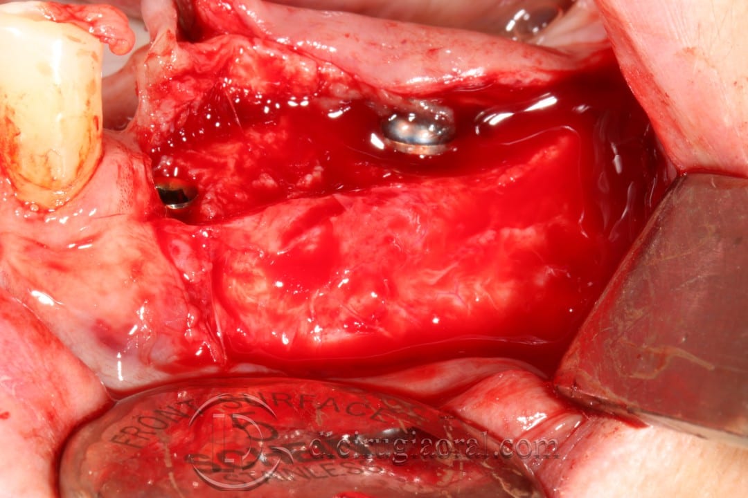 vestibuloplasty and implant in one surgery