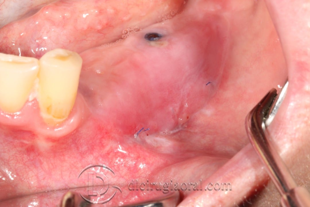 vestibuloplasty and implant in one surgery