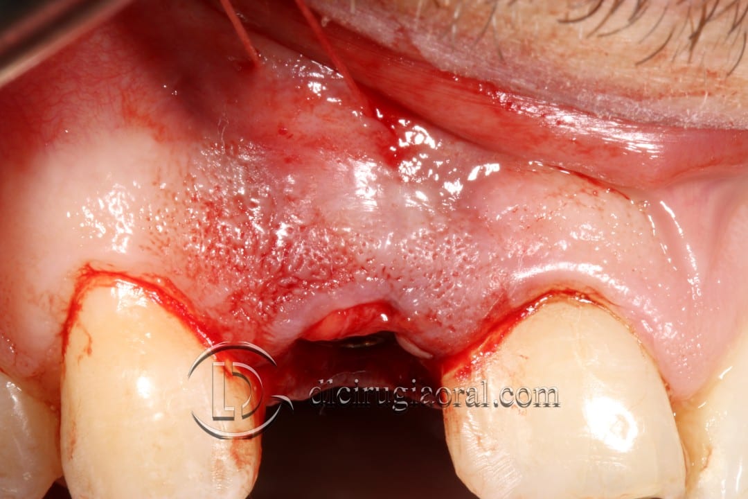 post-extraction implant connective tissue graft