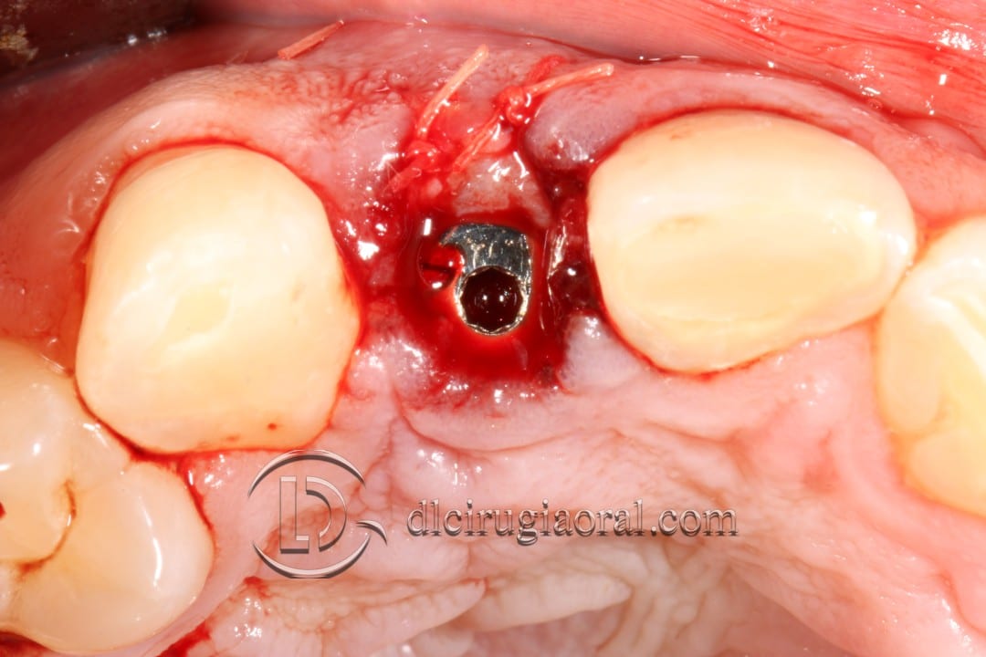 post-extraction implant connective tissue graft