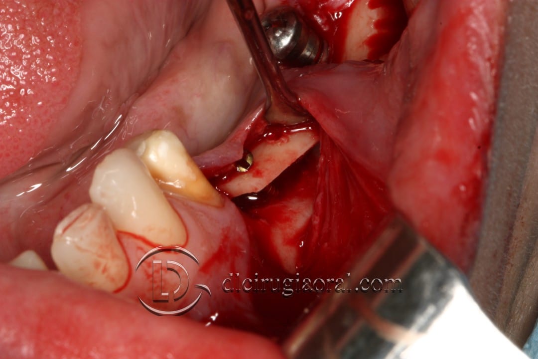 gaining height in posterior mandible