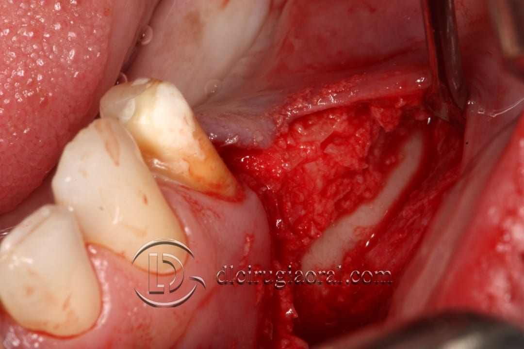 gaining height in posterior mandible